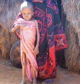 Unterernährtes Kind in Somalia