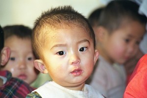 Mangelernährtes Waisenkind in Sariwon, Nordkorea 