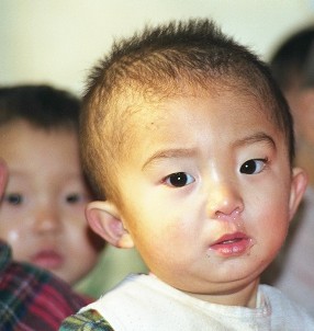 Mangelernährtes Waisenkind in Sariwon, Nordkorea